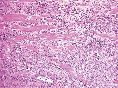 Fig. 10.30, Placental site trophoblastic tumor. The manner in which the neoplastic cells split the myometrial fibers is characteristic.