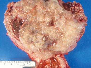 Fig. 10.3, Complete hydatidiform mole in a hysterectomy specimen. Note the classic hydropic translucent vesicles.