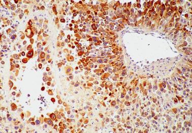 Fig. 10.31, Placental site trophoblastic tumor. The tumors cells are immunoreactive for human placental lactogen.