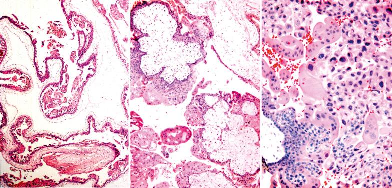 Fig. 10.4, Complete hydatidiform mole. Left: A large molar villus with a cistern and circumferential trophoblastic hyperplasia fills most of the field. Center: Early complete hydatidiform mole with club-like villi. Right: A villus (lower left) exhibits marked hyperplasia of cyto- and syncytiotrophoblast. There is also marked proliferation of extravillous trophoblast with nuclear atypia.