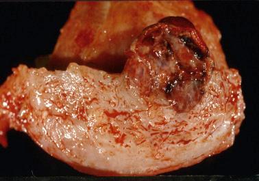 Fig. 10.6, Invasive hydatidiform mole. The neoplasm invades the superficial myometrium.