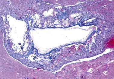 Fig. 10.7, Invasive hydatidiform mole. A molar villus with prominent circumferential trophoblastic hyperplasia is present within the myometrium.