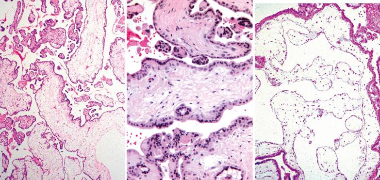 Fig. 10.8, Partial hydatidiform mole. Left: There are two populations of villi comprised of small fibrotic villi and large hydropic villi with scalloped outlines; note villus with cistern (lower right). Center: Note trophoblastic inclusions and syncytiotrophoblastic knuckles. Right: Note ectatic anastomosing villous vessels.