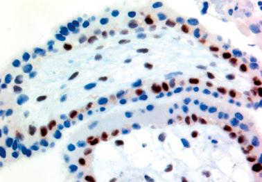 Fig. 10.9, Partial hydatidiform mole. The nuclei of most of the cytotrophoblastic cells and villous stromal cells are immunoreactive for p57.