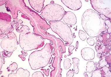 Fig. 10.10, Hydropic abortus. Note balloon-like villi with diffusely attenuated trophoblast.