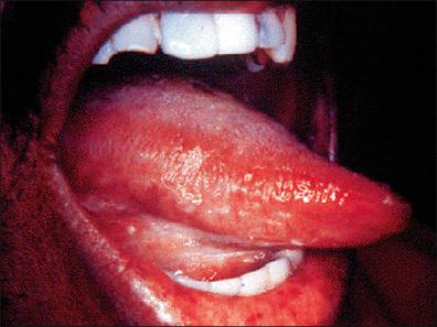 Figure 16-1, Oral hairy leukoplakia in an acquired immunodeficiency syndrome (AIDS) patient in India.