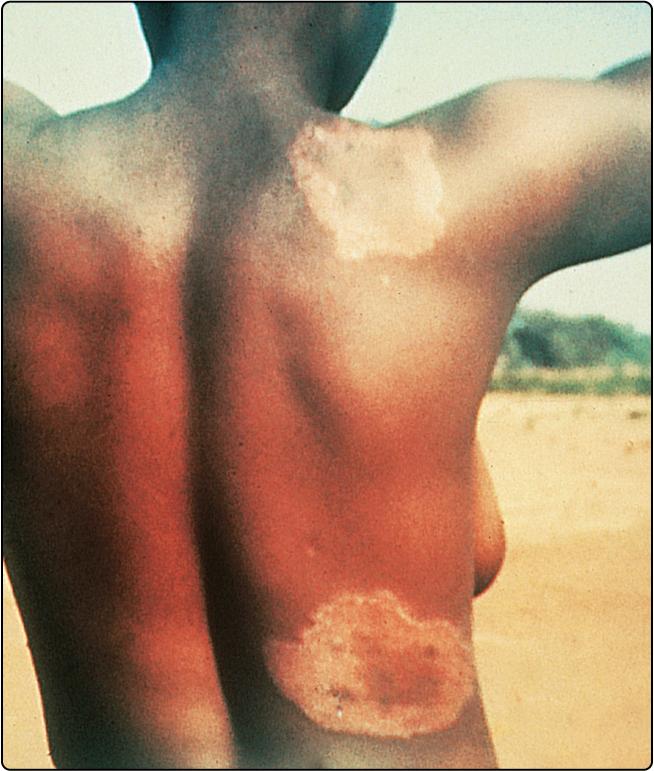 Fig. 34.1, Hypopigmented plaques of tuberculoid leprosy.