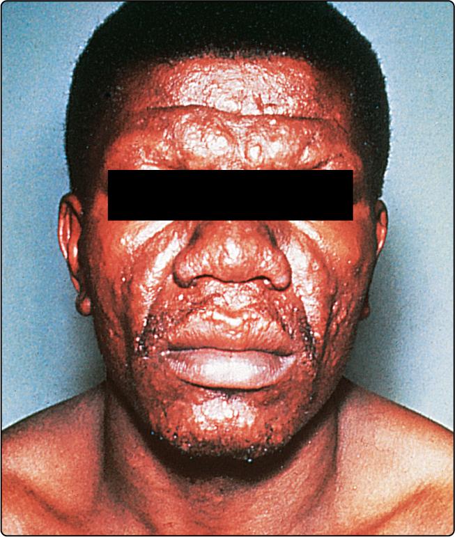 Fig. 34.2, The leonine facies of lepromatous leprosy.