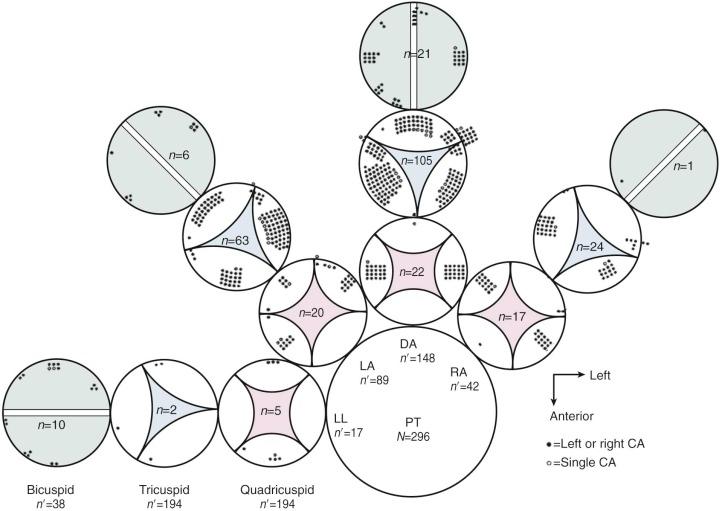 Figure 43-11, Position and rotation of trunk and coronary artery ostial positional variations in 296 cases of truncus arteriosus. For orientation, large circle represents position of a pulmonary root if it had formed. Trunk rotation places it in the left lateral (LL), left anterior (LA), direct anterior (DA), or right anterior (RA) position relative to the imaginary pulmonary root. Commissural positions for bicuspid, tricuspid, and quadricuspid valves are shown for each rotational position. Left and right coronary ostial (closed dots) and single coronary ostial (open dots) positions are shown relative to commissures. Key: CA, Coronary artery; PT, pulmonary trunk.