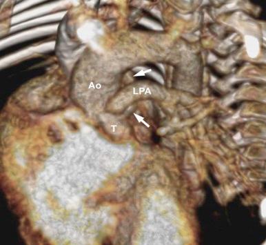 Figure 43-5, A volume-rendered image from a computed tomography angiogram of a 2-week-old neonate with truncus arteriosus, type II of Collette and Edwards. It shows that left and right branch pulmonary arteries (arrow) arise separately from the truncus arteriosus. Aorta is normal in appearance. Key: Ao, Aorta; LPA, left pulmonary artery; T, truncus.