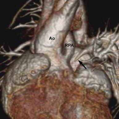 Figure 43-9, A volume-rendered image from a computed tomography angiogram of a 1-year old with complex truncus in which the right pulmonary artery (RPA) branch, but not the left (arrow) , arises from truncal root, coursing to the right lung posterior to ascending aorta (Ao). Left pulmonary artery has an atretic proximal component. Left lung is supplied by aortopulmonary collateral arteries.