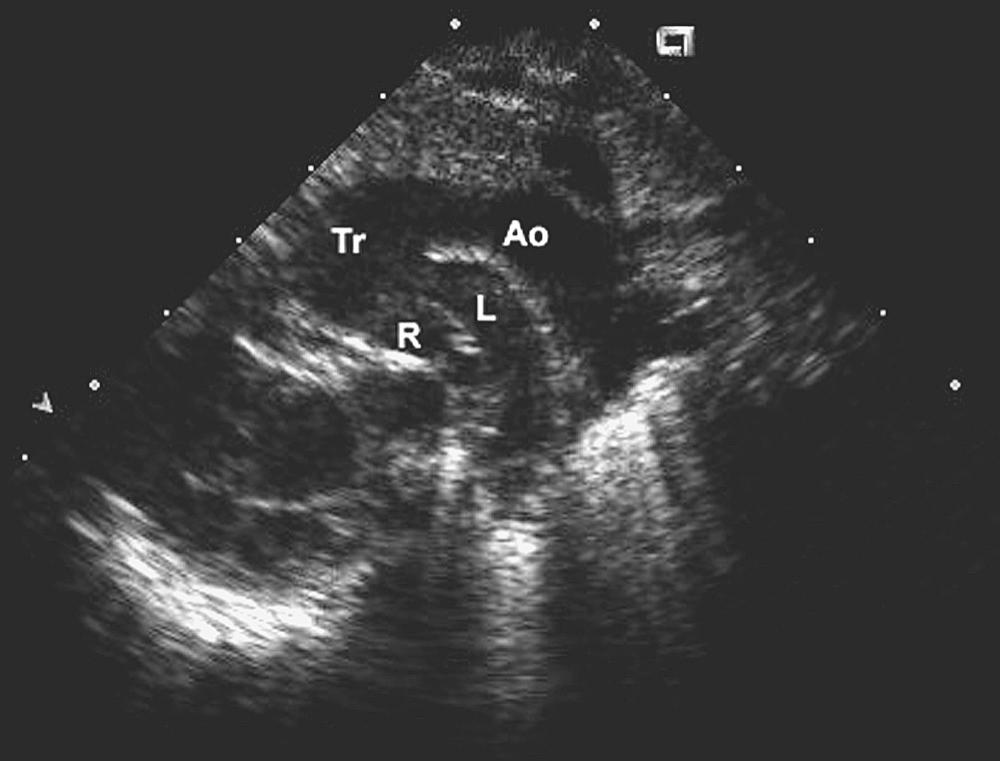 FIGURE 121-4, Suprasternal notch view demonstrating close but separate origins of the right (R) and left (L) pulmonary arteries from the truncus (Tr) with continuation as the aorta (Ao).