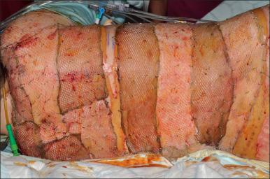 Fig. 52.1, Allograft cover of the back of an 80% total body surface area (TBSA) burn.