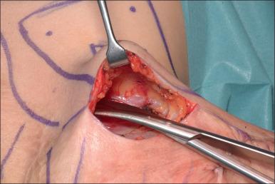 Fig. 52.11, Insertion of osmotic tissue expanders for reconstruction of chest burn scarring: pocket dissection.