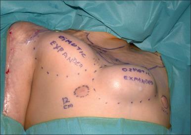 Fig. 52.15, Expanders after 2 months and prior to removal and reconstruction.