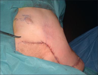 Fig. 52.18, Expanded skin flap advancement, reconstruction and closure.