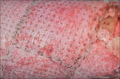 Fig. 52.2, Acute Meek autografting covering back skin following 80% total body surface area (TBSA) burn.