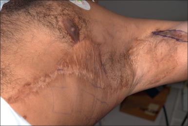 Fig. 52.4, Hyperpigmented scar on the left side of the chest following electrical injury.