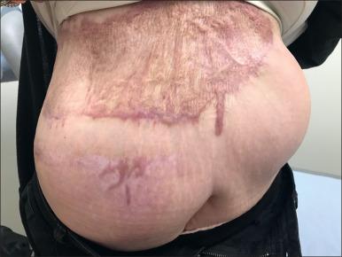 Fig. 52.5, Hypertrophic scar on the abdomen following flame burn.