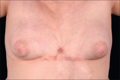 Fig. 52.7, Unstable scar in the center of the chest after flame burns treated conservatively.