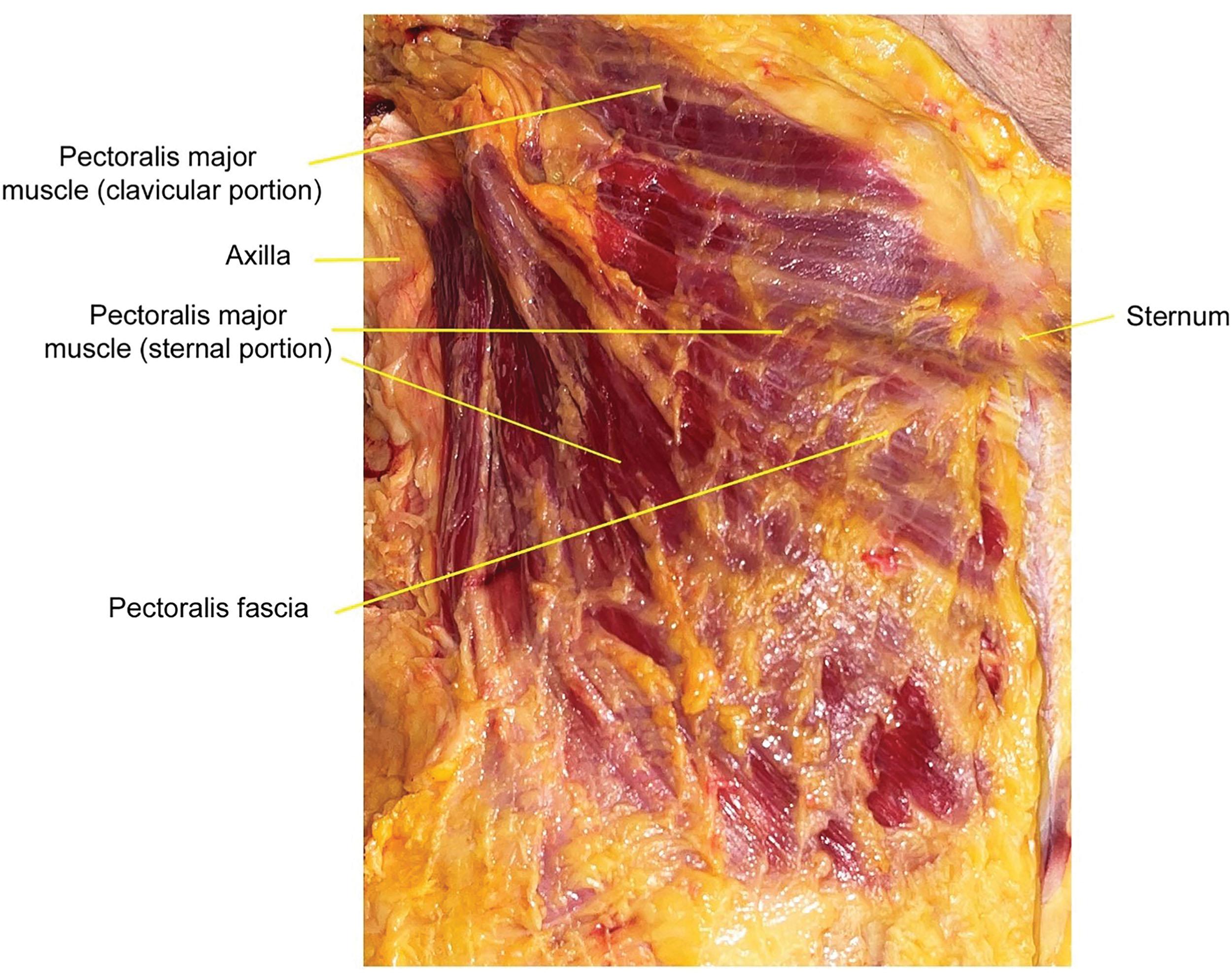 Figure 10.3, Cadaver dissection of the pectoralis major muscle.