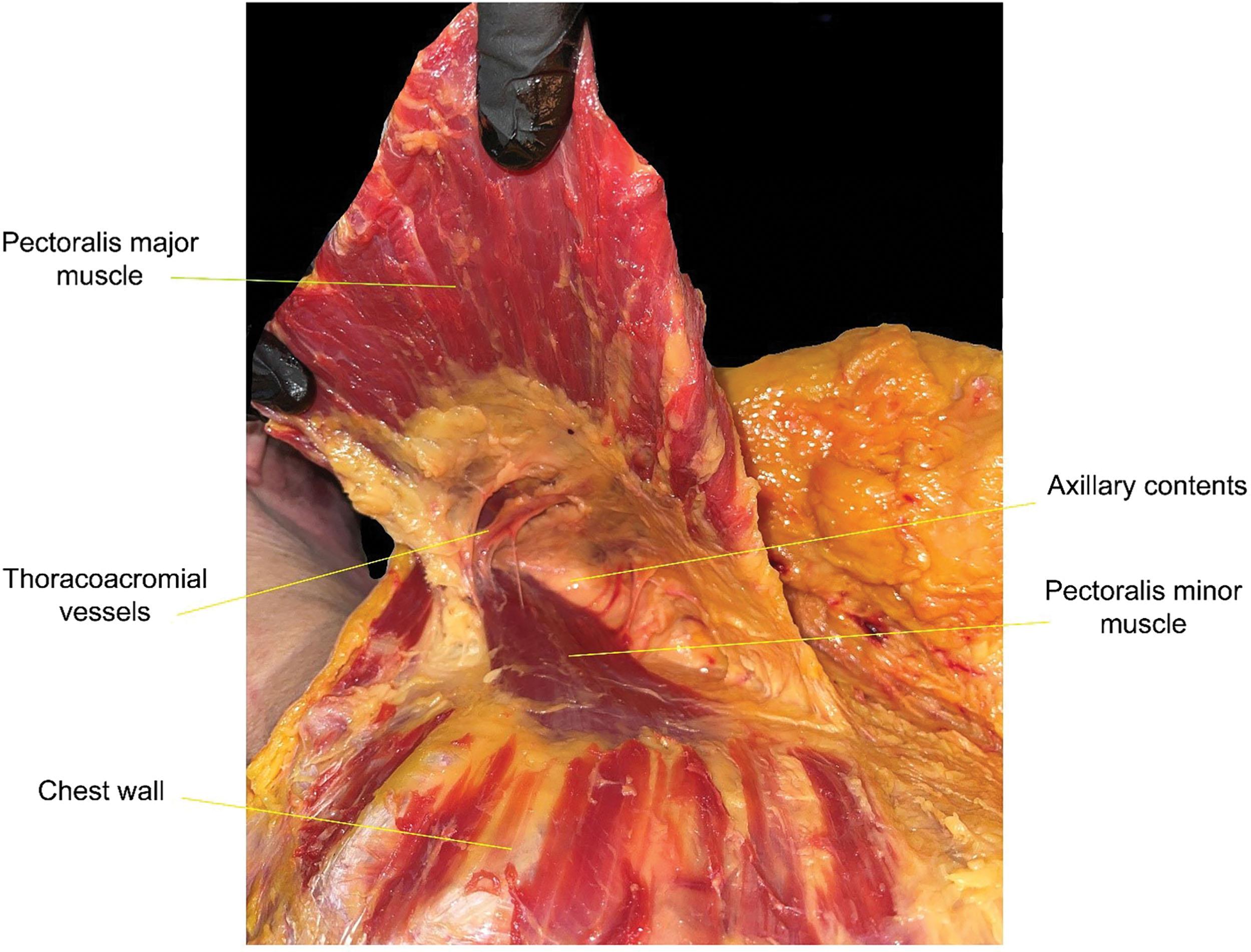 Figure 10.4, Cadaver dissection of the pectoralis major muscle elevated to show its blood supply.