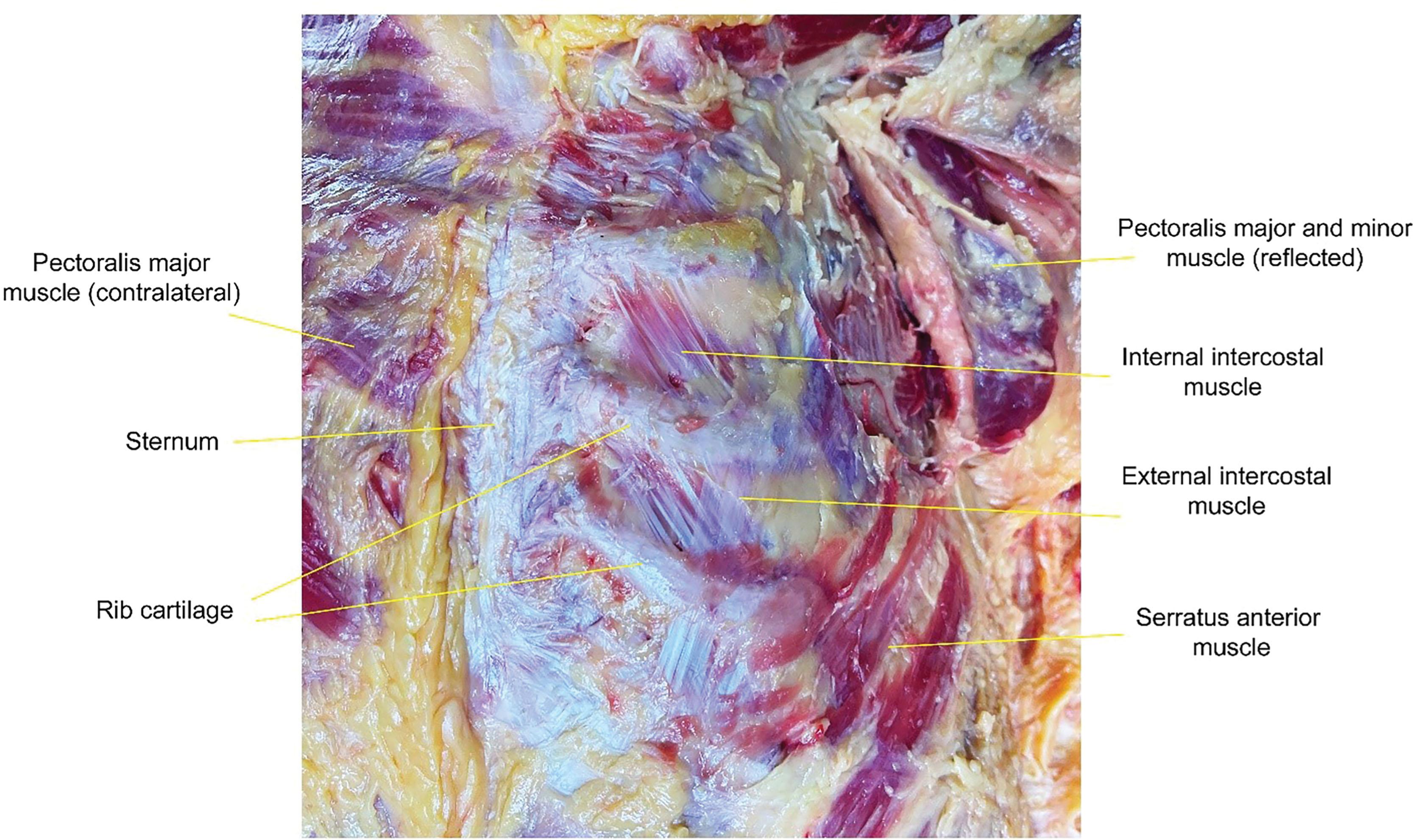 Figure 10.5, Cadaver dissection of the anterior chest showing the intercostal muscles.