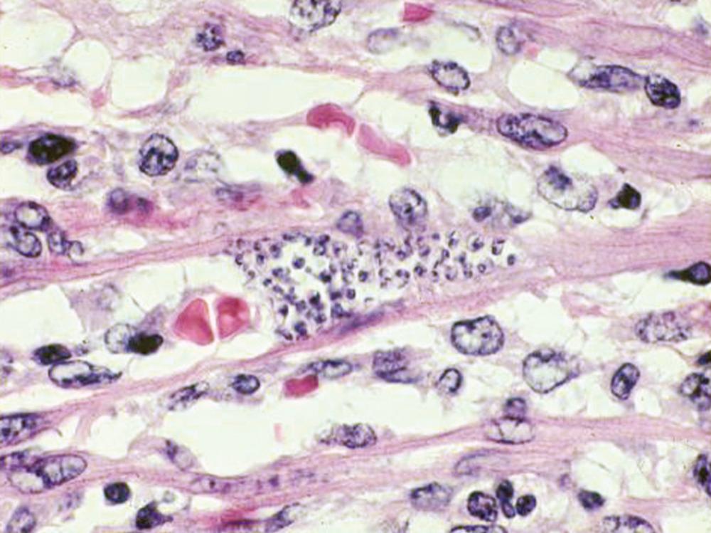 FIG. 276.4, Trypanosoma cruzi in the cardiac muscle of a child who died of acute Chagas disease in Texas (see reference 20 ). (Hematoxylin & eosin stain; magnification ×900).