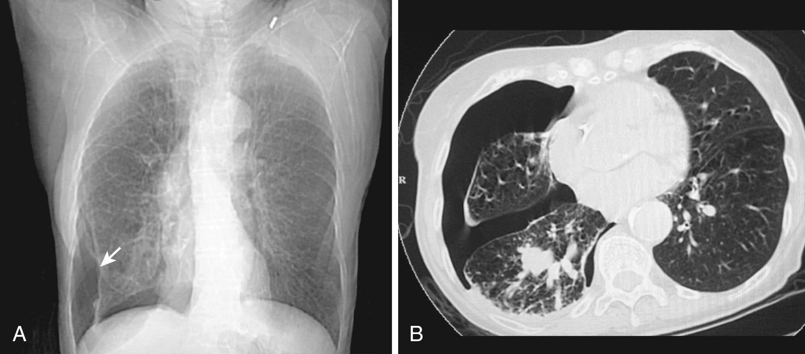 Figure 10.1, Pneumothorax. A, Anteroposterior chest radiograph of a right-sided, seemingly small, simple pneumothorax (PTX). Note the absence of peripheral lung markings on the right side and the distinct line indicating the edge of the collapsed lung (arrow). Although this appears to be a small PTX, it produced significant dyspnea in this patient with chronic obstructive pulmonary disease and therefore required a chest tube. B, Computed tomography scan showing the extent of the collapse. Adhesions kept part of the lung expanded.