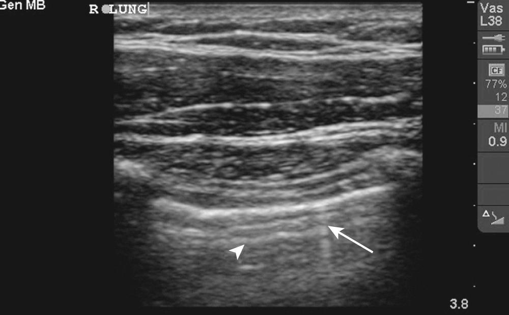 Figure 10.US3, This image demonstrates two key artifacts seen in a normal lung. As with the previous image, the pleura is recognized as a hyperechoic horizontal line deep to the ribs (at the far right and left of the image). A comet tail, a small vertical line, can be seen extending deep to the pleura (arrow). This is a normal artifact created by the pleura, and its presence aids in ruling out a pneumothorax. A-lines, or a series of horizontal lines extending deep to the pleura, can also be seen (arrowhead). These artifacts may be seen both in normal lungs and in the presence of pneumothorax.