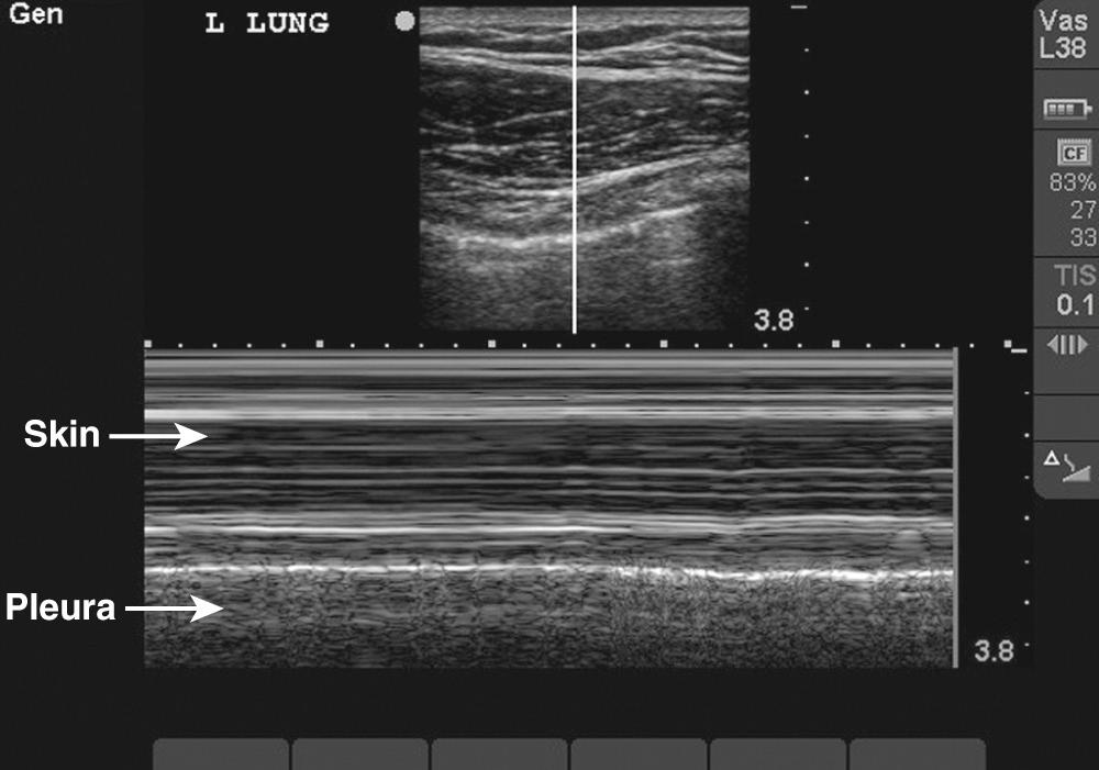 Figure 10.US4, Seashore sign seen in a normal lung. This M-mode image shows movement of the pleura. The solid lines at the top of the image represent the immobile skin, soft tissue, and muscle. The hazy lines at the bottom of the image represent the back-and-forth movement of the normal pleura.