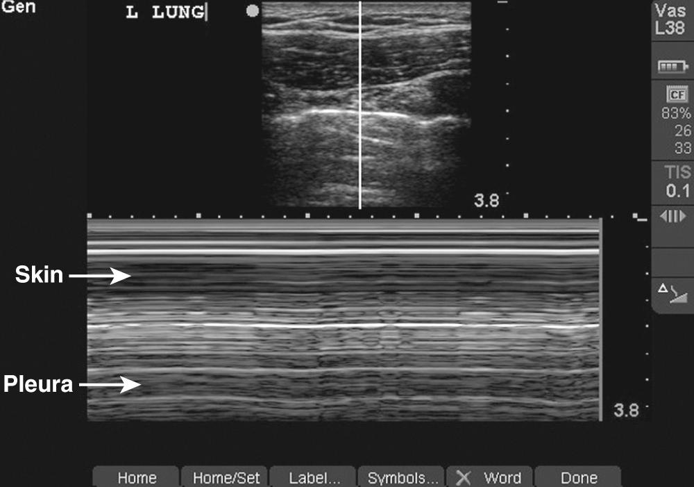 Figure 10.US5, Bar code sign consistent with a pneumothorax. This M-mode image shows lack of movement of the pleura. Unlike the previous image, the solid lines can be seen to continue past the point of the pleural line. Because the presence of the pneumothorax causes the pleura to appear stationary, no movement is seen in this image.