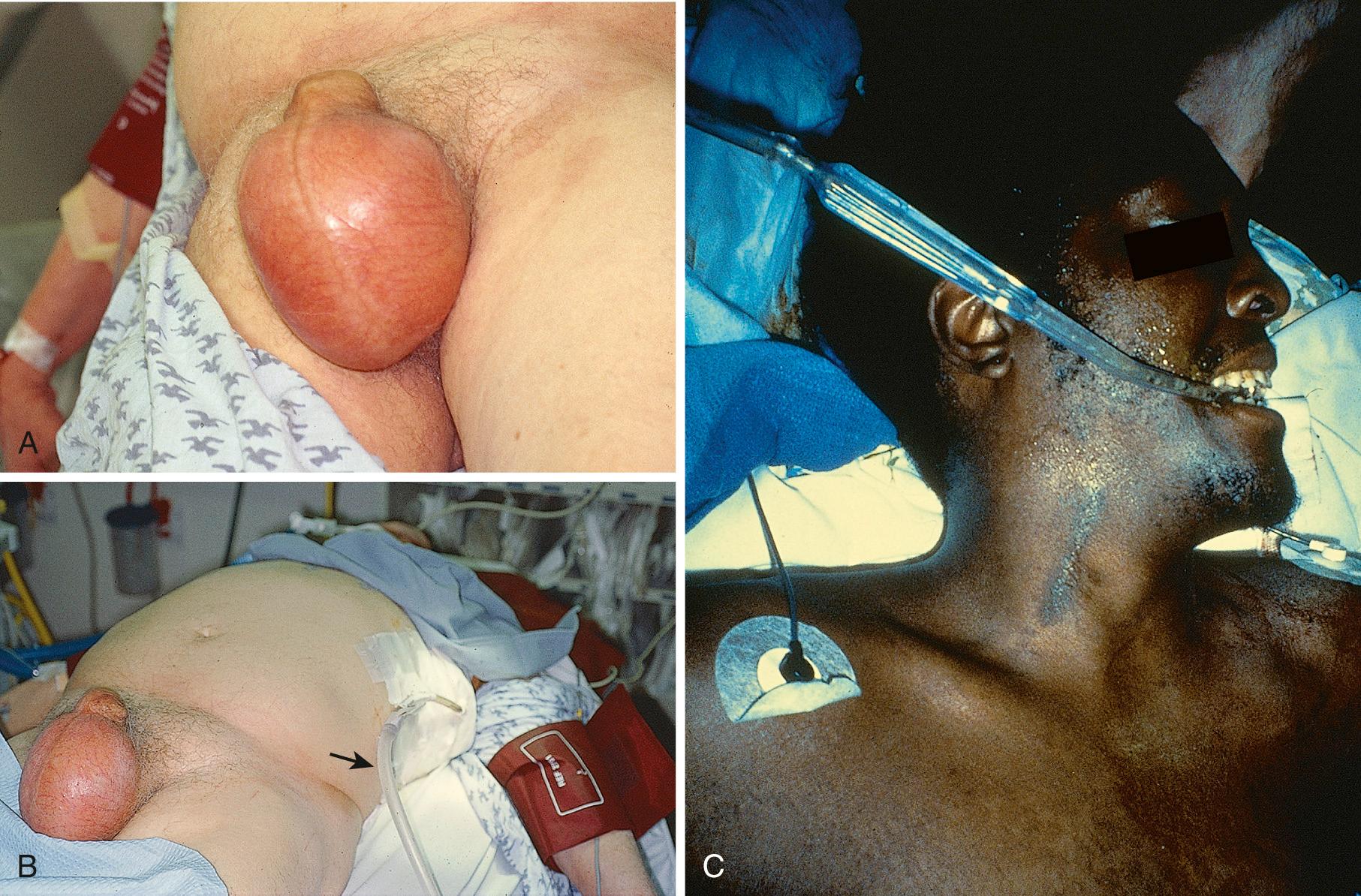 Figure 10.2, A, After successful cardiopulmonary resuscitation and intubation, this patient began to deteriorate, with a precipitous drop in blood pressure and decreasing oxygen saturation. It was believed that the cause of the initial cardiac arrest was returning. Marked subcutaneous air was noted in the scrotum and abdominal wall, but little air was noted in the chest wall tissue. The subcutaneous air from a pneumothorax and positive pressure ventilations created by the resuscitation had curiously tracked via abdominal wall tissue planes, a distinctly unusual place for air to accumulate. Usually subcutaneous air is felt around the chest tube insertion site, neck, and chest wall. B, A chest tube (arrow) quickly reversed the decompensation from the pneumothorax. C, This patient suffered respiratory arrest from heroin injected into a neck vein (note the extensive scar). After bag-mask resuscitation the respiratory depression returned and the blood pressure dropped precipitously. He was unresponsive to naloxone and was very difficult to ventilate. He had a small pneumothorax from a nick in the lung from the neck injection. The positive pressure ventilations produced a tension pneumothorax.