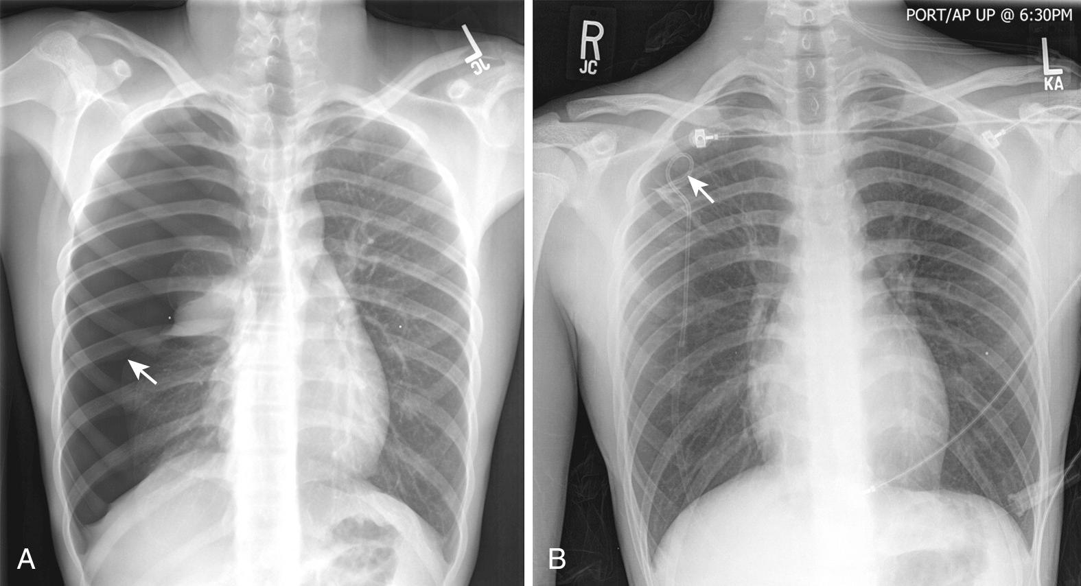 Figure 10.3, Spontaneous pneumothorax. A, Spontaneous pneumothorax in a young male patient. There is nearly total collapse of the right lung, and lung markings are absent lateral to the visible pleural reflection (arrow). Note also the slight deviation of the mediastinum to the contralateral side. B, The patient was treated with a pigtail catheter inserted in the second intercostal space in the midclavicular line (arrow). Note that the lung has totally reexpanded and the mediastinum has shifted back to the midline.