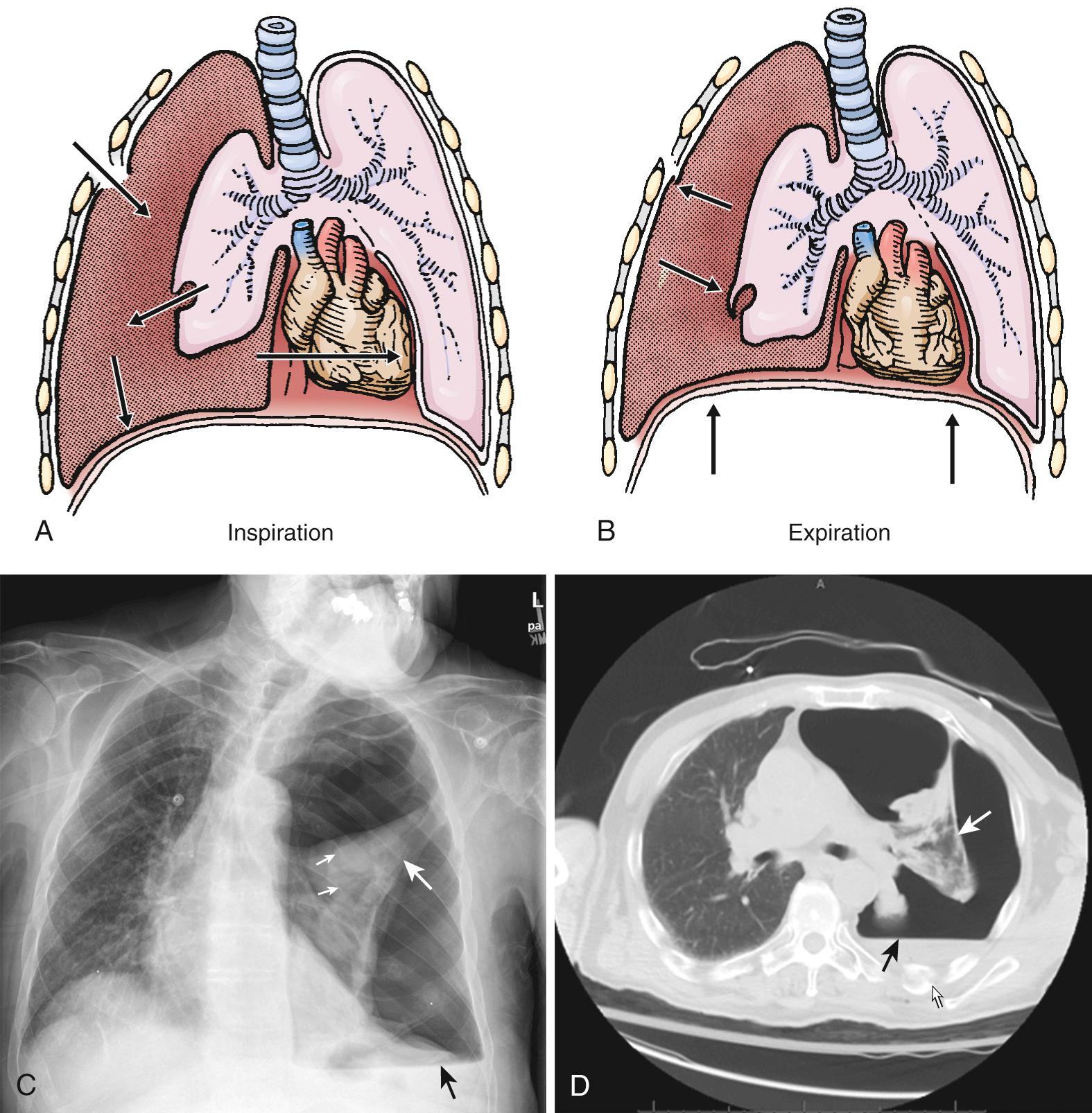 Figure 10.4, Traumatic tension pneumothorax. A and B, Pathophysiology of a tension pneumothorax. During inspiration, air enters the pleural space through a one-way valve either from the outside or from the lung itself. On expiration, the injury/valve closes and traps increasing amounts of air in the pleural space. Eventually, the mediastinum shifts and cardiac filling and ultimately cardiac output are compromised. C, This elderly patient sustained a tension hemopneumothorax after slipping and falling on ice. The left hemithorax is very dark (radiolucent) because of total collapse of the left lung (large white arrow). Note the dramatic shift of the mediastinum to the right, indicative of tension. Multiple posterior rib fractures are present but are difficult to appreciate on this film (small white arrows). The air-fluid level (black arrow) indicates the presence of air in the pleural cavity in addition to fluid (blood). D, A computed tomography scan of the same patient again demonstrates the findings seen on the conventional radiograph.