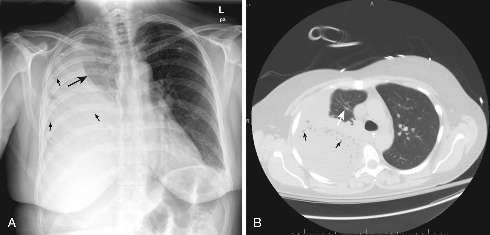 Figure 10.5, Empyema. This 34-year-old patient with a history of alcoholism had fever, cough, pleuritic chest pain, and hypoxia. A, Posteroanterior chest radiograph demonstrating nearly total opacification of the right hemithorax. The presence of a meniscus (large arrow) suggests a pleural effusion. However, small lucent areas (small arrows) can be seen throughout the opacity, which may represent air bronchograms in consolidated lung parenchyma. Thus, a computed tomography (CT) scan was performed. B, CT revealed nearly total collapse of the right lung with only a small portion of the apex remaining inflated (white arrow). A massive pleural collection was found with gas bubbles throughout (black arrows), suggestive of pyogenic empyema. Tube thoracostomy was performed and more than 1700 mL of purulent fluid was drained. Fluid cultures grew Streptococcus anginosus .