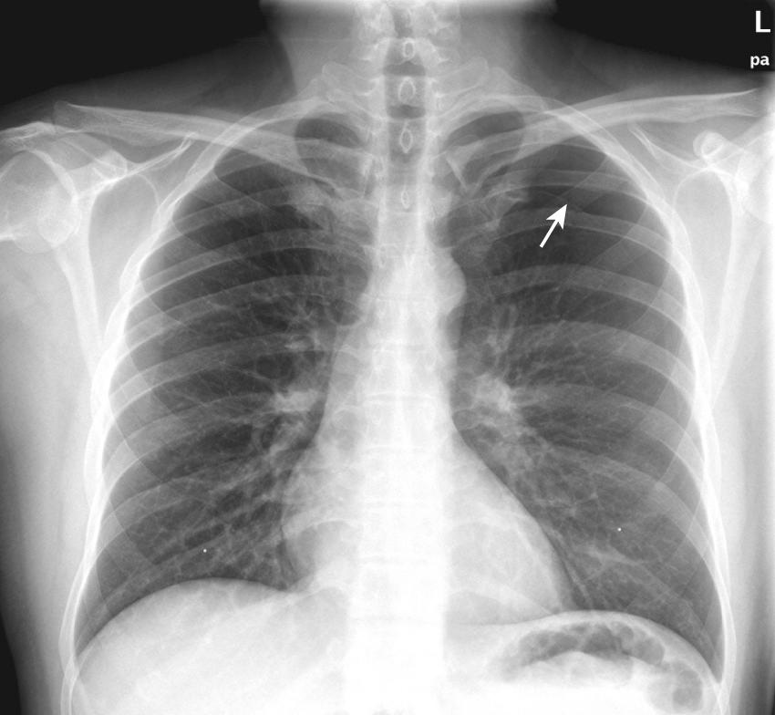 Figure 10.6, Smaller pneumothoraces such as this (note the faintly visible pleural reflection [arrow], absence of lung markings at the left apex, and relative crowding of vessels at the left hilum) can be difficult to see on radiographs and even harder—if not impossible—to appreciate on physical examination. Patients with a pneumothorax of less than 20% will often have completely normal findings on chest examination, including equal breath sounds.