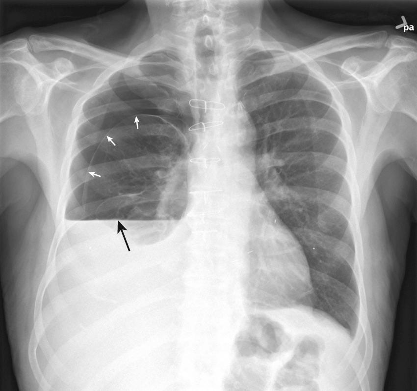 Figure 10.7, Hydropneumothorax. This radiograph is an excellent example of a hydropneumothorax. When accumulated fluid in the chest cavity is seen as a straight line on a radiograph (an air-fluid level [black arrow] ) with no meniscus up the side, air must be present in the pleural space. In this patient the pneumothorax is readily visualized, with no lung markings seen laterally or superior to the pleural reflection (white arrows).