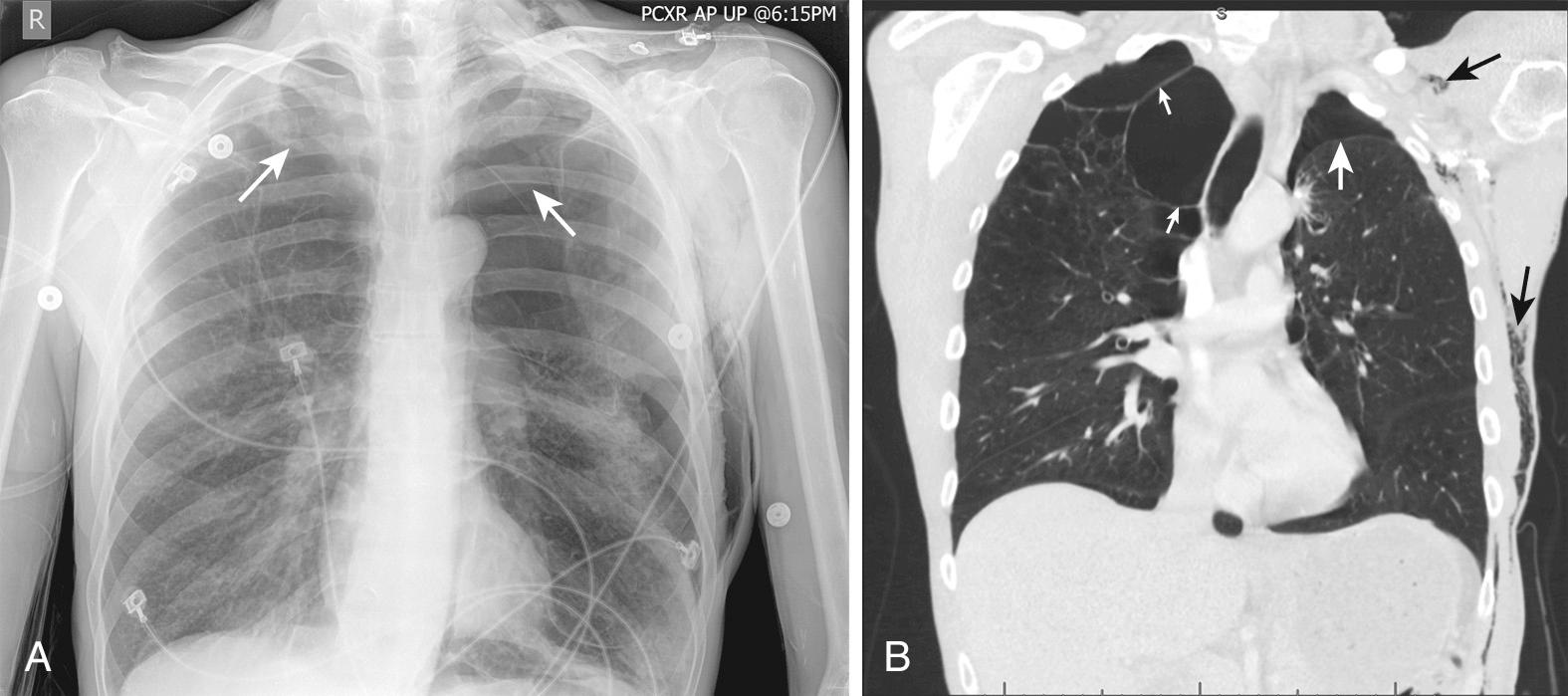 Figure 10.8, Pneumothorax and bullous emphysema. This patient had a history of severe chronic obstructive pulmonary disease and arrived at the emergency department in respiratory distress. A, On the chest radiograph, both apices are relatively radiolucent and faint lines that are not clearly blebs or pleural reflections (arrows) can be seen coursing through. B, A computed tomography scan was obtained and defined the pathology in detail. In the right apex, there is no pneumothorax, but rather large blebs are present (small white arrows). On the left a pleural reflection is clearly visible (large white arrow), indicative of pneumothorax. Subcutaneous air is also noted in the thoracic soft tissues (black arrows), thus further supporting the diagnosis of pneumothorax. (This finding is also evident on the chest radiography but was overlooked on the initial interpretation.)