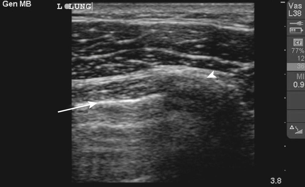 Figure 10.US2, Ultrasound image of the pleura as seen with a high-frequency transducer. The pleura can be recognized as a hyperechoic (white) line (arrow) that normally moves back and forth with respiration. Identifying the rib, along with its accompanying shadow (arrowhead), often aids in identifying the pleura because it will lie immediately deep to the rib.