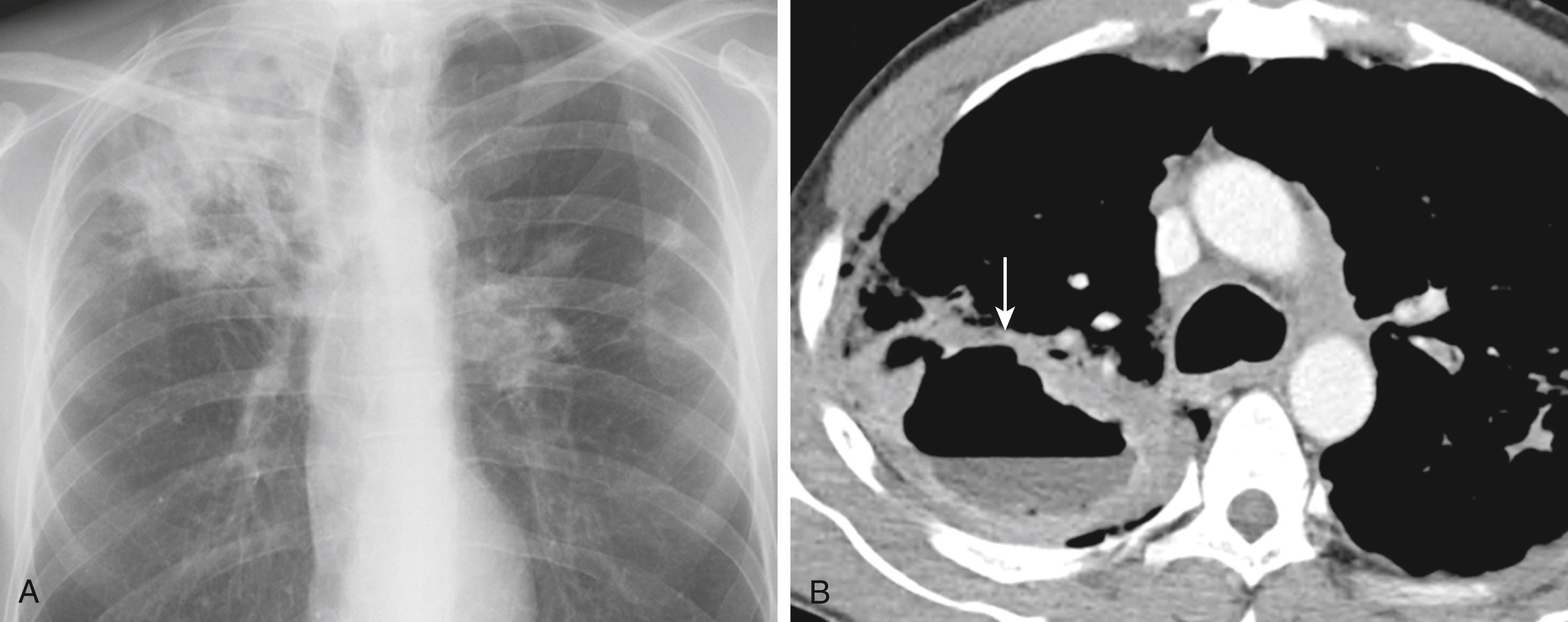 FIGURE 299-5, Cavitary tuberculosis.