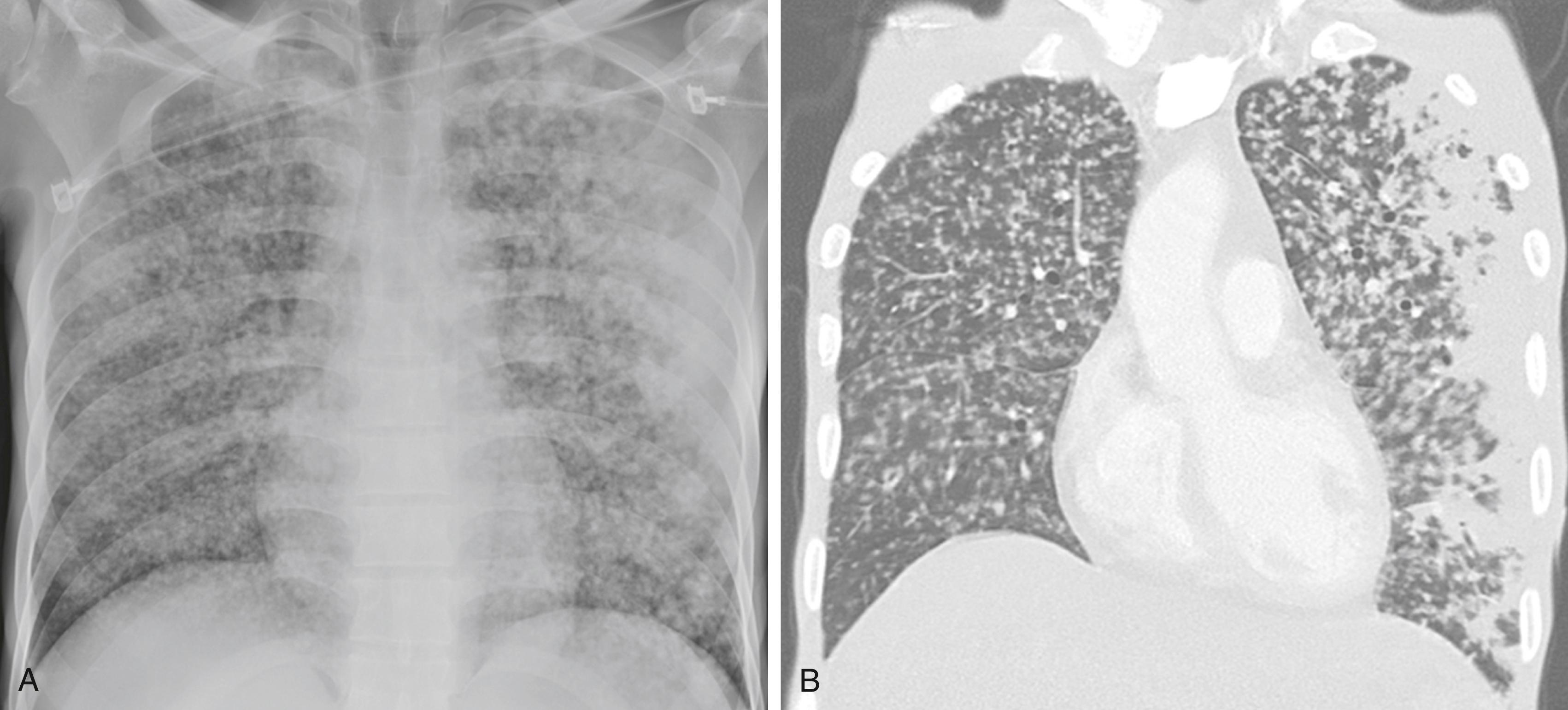 FIGURE 299-6, Miliary tuberculosis (TB).