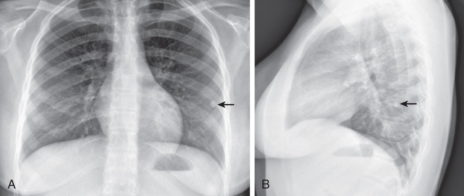 Fig. 242.6, Posteroanterior ( A ) and lateral ( B ) chest radiograph images of an adolescent showing a 7 mm calcified granuloma in the left lower lobe (arrows) .
