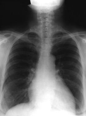 Figure 20-1, The roentgenogram from this patient demonstrates calcification of the hilar lymph nodes from the acquisition of tuberculosis.
