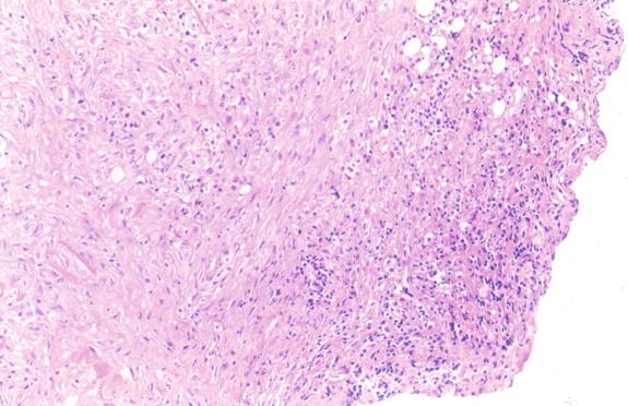 Figure 20-11, The lymph node of the patient in Figure 20-10 contained M. tuberculosis, which is essentially replaced by predominantly fibrous tissue. H&E stain, 100 × magnification.