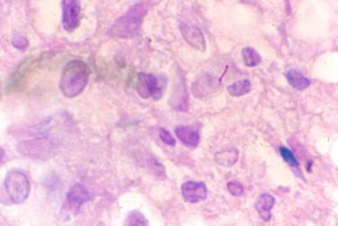 Figure 20-12, The tuberculous bacillus present in the fibrous pseudotumor of the patient in Figures 20-10 and 20-11 . Fite, 1500 × magnification.