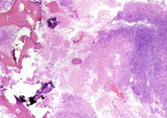 Figure 20-2, This patient had reactivation tuberculosis in the head of the femur that was thought to radiographically represent an osteosarcoma. A necrotizing granuloma seen here is associated with bone. Frozen section and histopathology categorized the lesion as infectious and due to mycobacteria, whereas molecular tools, and subsequently culture, were used to identify the etiologic agent as M. tuberculosis. H&E stain, 40 × magnification.