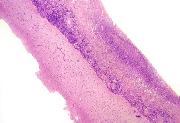 Figure 20-3, The meninges of this patient with culture-proven tuberculous meningitis demonstrated necrotizing granulomas within the meninges, characteristic of this disease. H&E stain, 40 × magnification.