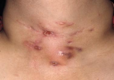 Figure 20-5, Draining sinus tracts have developed in this patient with tuberculosis.