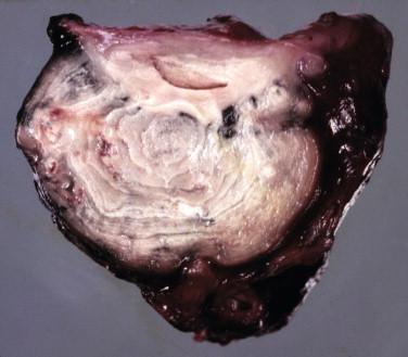 Figure 20-6, This granuloma from a patient with tuberculosis demonstrates a white-to-tan, creamy interior, with concentric rings that may be appreciated with these lesions.